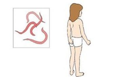 crijevni paraziták kod djece